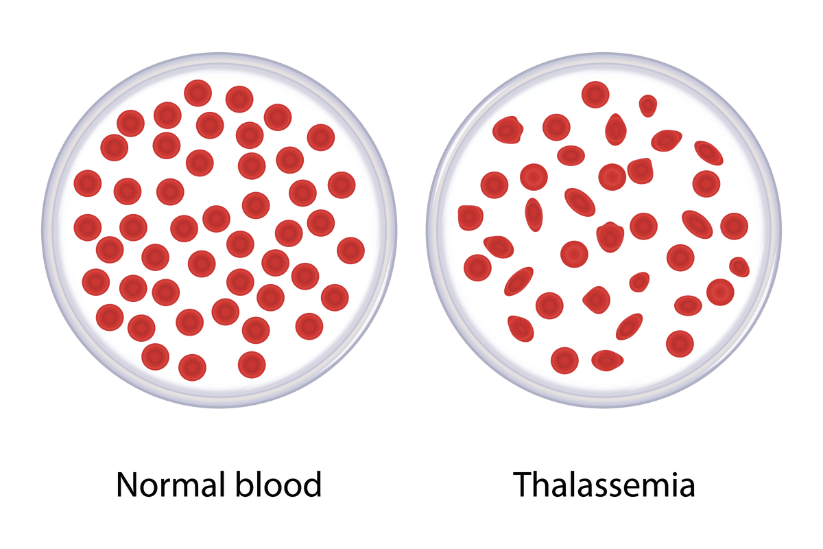 تالاسمی یک نوع اختلال خونی ارثی می باشد که در آن تولید هموگلوبین (پروتئین حامل اکسیژن درگلبول های قرمز خون) کاهش پیدا می کند. این مسئله باعث کمبود گلبول های قرمز در خون و همچنین کاهش سطح اکسیژن در جریان خون و نهایتا طیفی از مشکلات در سلامتی فرد شود.