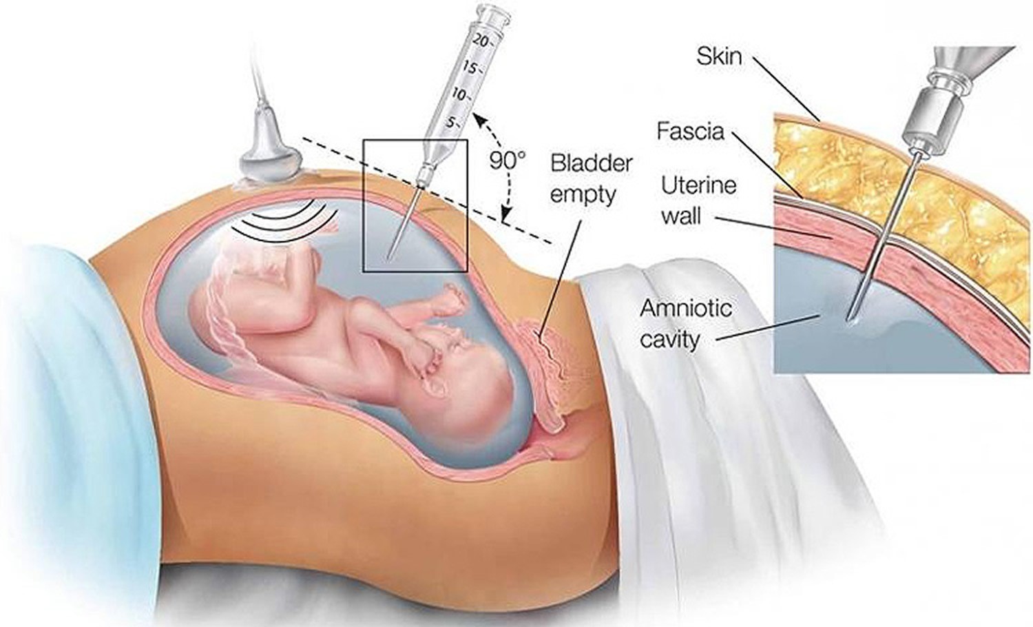 آمنیوسنتز یک آزمایش پیش از تولد است که برای مادران بارداری که ریسک بالاتری برای به دنیا آوردن نوزاد ناقص داشته باشند، انجام می شود. این آزمایش بر روی مایع آمنیون (مایع داخل کیسه ی اطراف جنین)  انجام می شود.