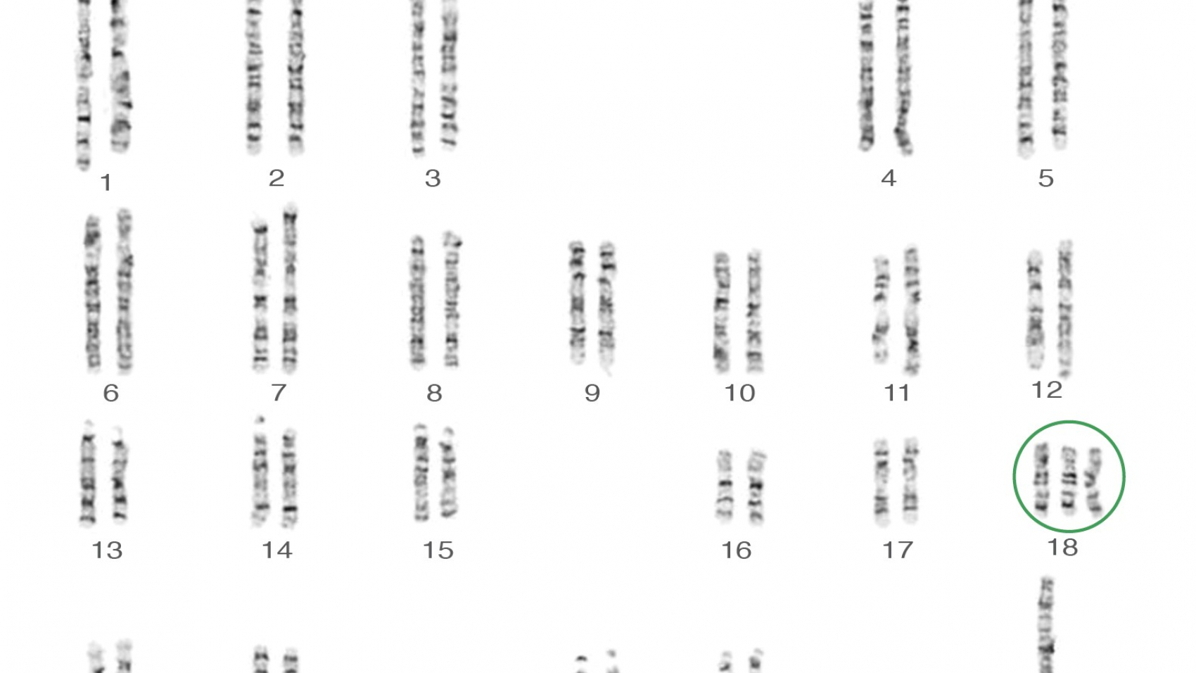 B9---Trisomy-18-Karyotype-47XY18