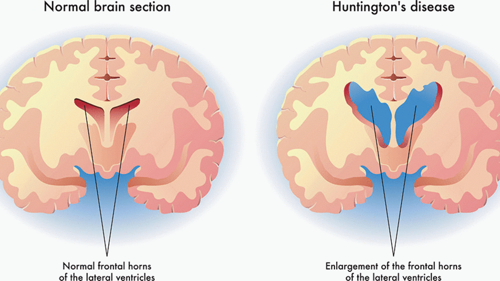 huntingtons-disease-illustration-1f8fe4