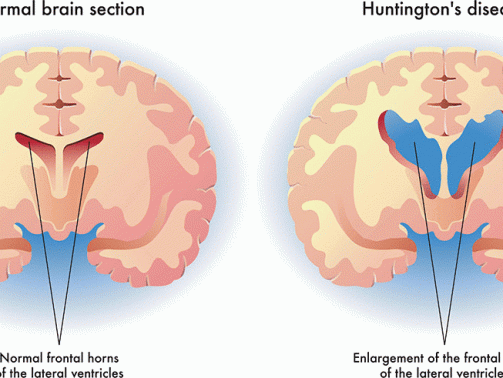 huntingtons-disease-illustration-1f8fe4