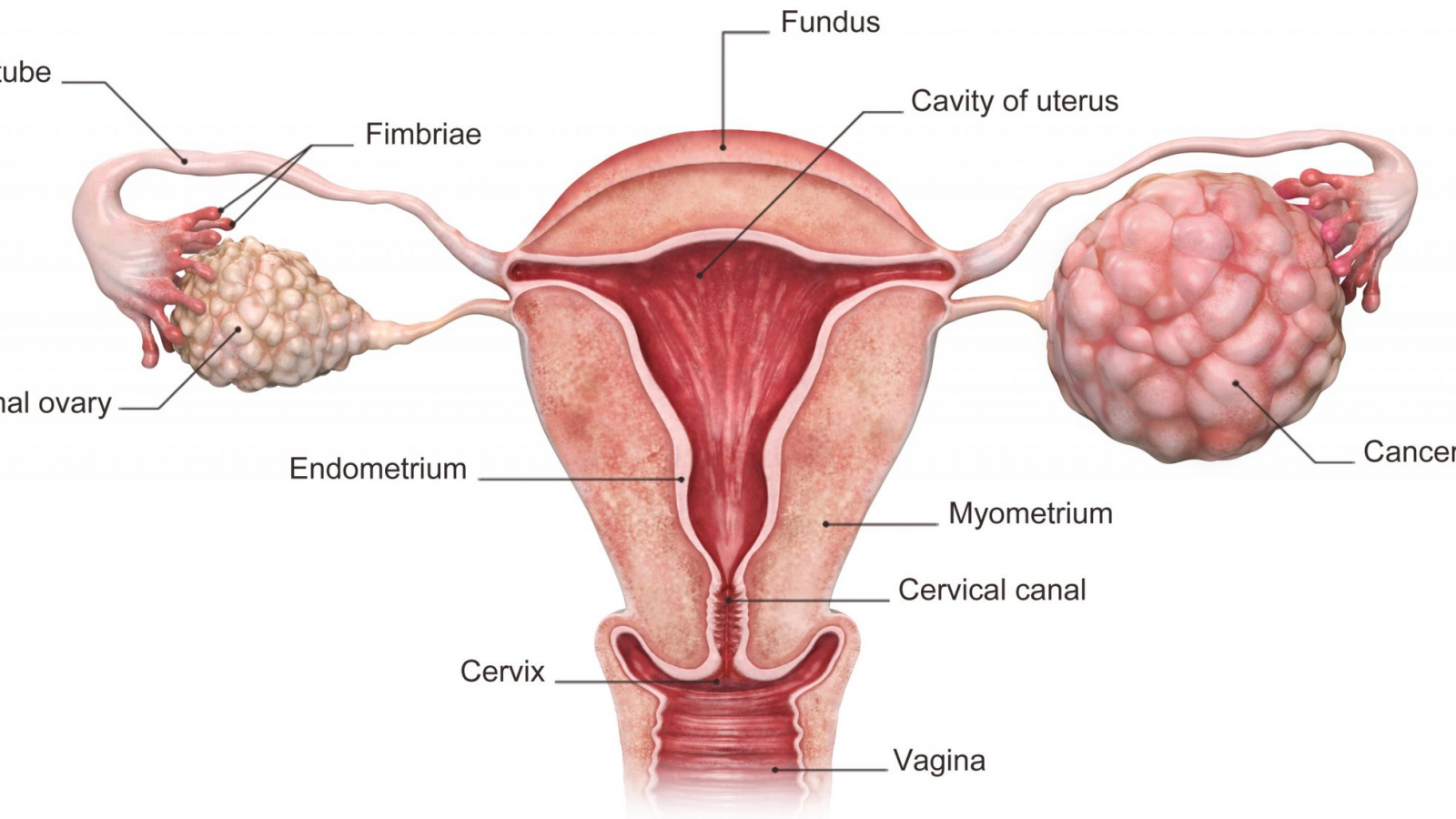 3d rendered illustration of the ovarian cancer.