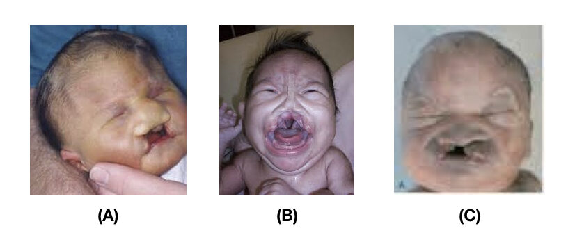 سندرم داون  (تریزونی 21) ، سندرم ادوارد (تریزومی 18)، و  سندرم پاتو(تریزومی 13) رایج ترین اشکال تریزومی هستند. کودکان مبتلا به تریزومی معمولاً دارای طیف وسیعی از ناهنجاری های هنگام تولد، از جمله تأخیر در رشد و اختلالات ذهنی هستند.