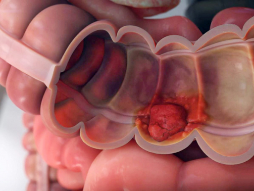 1800x1200_crohns_colorectal_cancer_animation_video