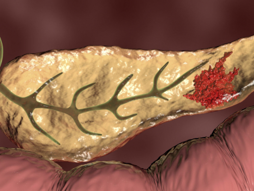 Pancreatic cancer. Computer illustration showing a malignant (cancerous) growth (red) in the pancreas (yellow). Pancreatic cancer often causes no symptoms until it is well established and untreatable.