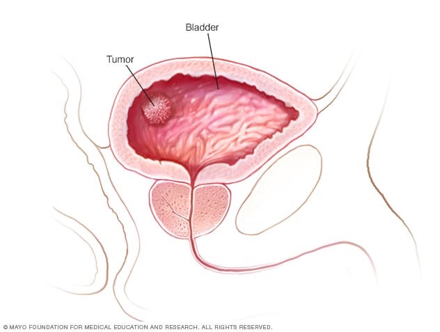 سرطان مثانه نوعی سرطان شایع است که از سلول¬های مثانه شروع می شود. سرطان مثانه اغلب از سلول¬ها (سلولهای ادراری) که در داخل مثانه قرار دارند ، شروع می شود. سرطان می تواند در کلیه ها نیز اتفاق بیفتد، اما شیوع آن در مثانه بسیار بیشتر است.