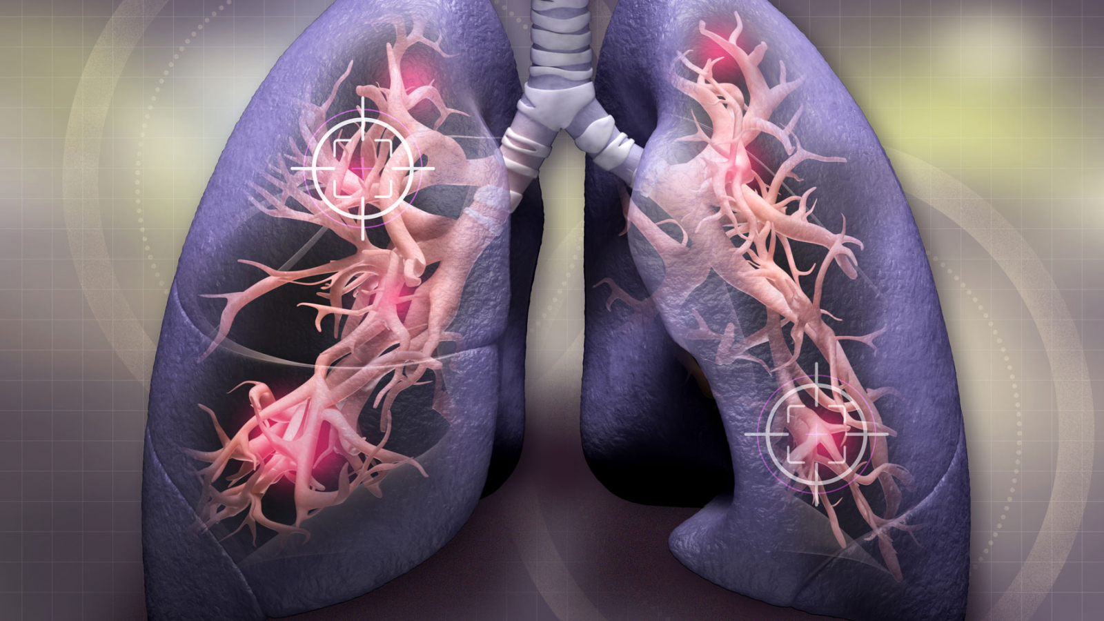 سرطان ریه نوعی سرطان است که از ریه ها شروع می شود. ریه ها دو اندام اسفنجی در قفسه سینه هستند که هنگام استنشاق اکسیژن دریافت می کنند و هنگام بازدم دی اکسید کربن آزاد می کنند.