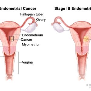 اگرچه برخی از عوامل می توانند خطر ابتلا به سرطان آندومتر در زن را افزایش دهند ، اما همیشه باعث بیماری نمی شوند. بسیاری از زنان با عوامل خطر هرگز به سرطان آندومتر مبتلا نمی شوند.