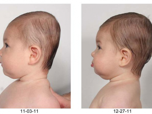 سندروم سر صاف یا پلاژیوسفالی زمانی گفته می شود که یک لکه ی صاف در پشت یا کناره های سر نوزاد تشکیل می شود. این حالت که باعث عدم تقارن در سر نوزاد می شود و تعدادی حالت سر در این سندروم را هنگامی که از بالا به آن نگاه می کنیم را شبیه متوازی الاضلاع توصیف می کنند. جمجمه ی نوزاد تا چندین ماه بعد از تولد به سختی و حتی به طور کامل تشکیل نمی شود. و همچنین نرمی استخوان سر نوزاد که باعث می شود سر به راحتی تغییر شکل دهد. یکی از علل رایج این سندروم خوابیدن مداوم نوزاد در یک حالت یکسان می باشد.