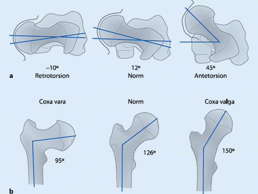 به تغییر شکل (بد شکلی) قسمت فوقانی ران که در قسمت داخلی لگن قرار می گیرد coxa Valga گفته می¬شود. تغییر شکل لگن به گونه ای است که در آن زاویه بین محور استخوان ران و سر استخوان ران بسیار زیاد می¬باشد. در اکثر افراد سر استخوان ران با تنه استخوان زاویه 120-130 درجه می سازد که در coxa valga این زاویه از 130 درجه بیشتر می¬شود.
