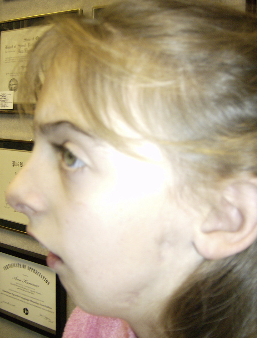 micrognathia شرایطی است که در آن فک پایینی کوچک تر از حالت معمول می¬باشد. این حالت یکی از علایم انواع craniofacial condition  است. گاهی به نام mandibular hypoplasia نامیده می¬شود. میکرونیشن ممکن است در نحوه غذا خوردن و نفس کشیدن کودک دخالت داشته باشد. 