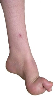 بیماری شارکوت ماری توث باعث ضعیف شدن و کوچک تر شدن عضلات می شود. ممکن است حتی فرد حس از دست دادن انقباضات عضله خود را تجربه کند و به سختی حتی بتواند راه برود. دفرمه شدن پاها همانند خم شدن انگشتان نیز بسیار متداول است. 