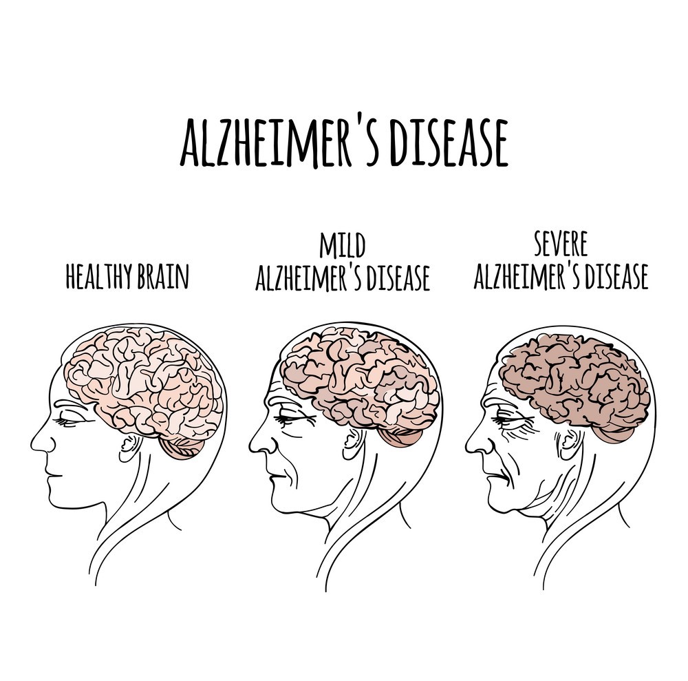 بیماری آلزایمر یک اختلال عصبی پیشرونده است که باعث کوچک شدن مغز (آتروفی) و مرگ سلول های مغزی می گردد. بیماری آلزایمر شایع ترین علت زوال عقل است و کاهش مداوم مهارت های تفکر، مهارت های رفتاری و اجتماعی که بر توانایی فرد برای عملکرد مستقل تأثیر می گذارد را در بر دارد.