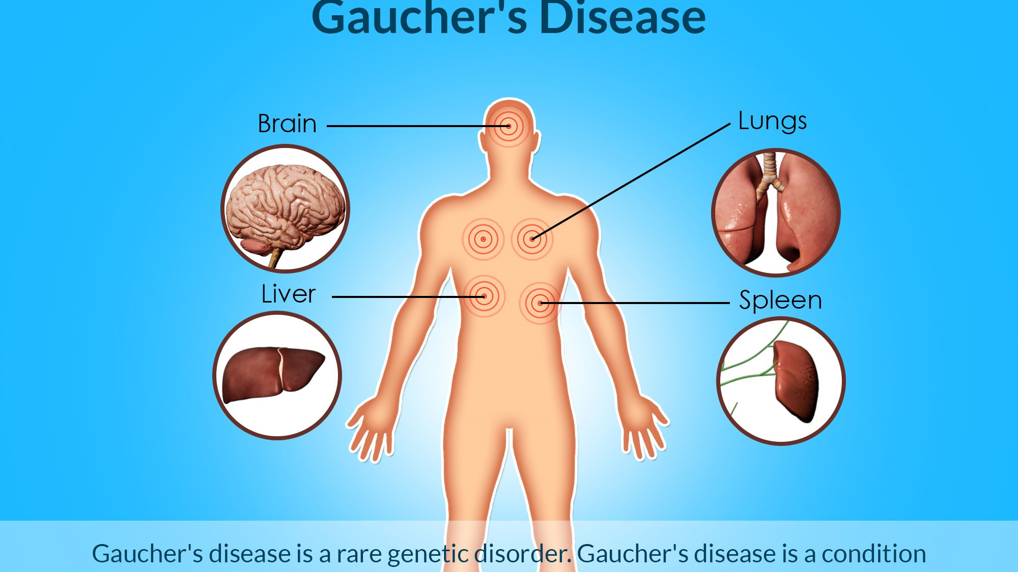 gauchers-disease
