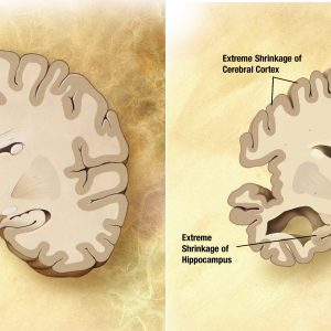 بیماری آلزایمر یک اختلال عصبی پیشرونده است که باعث کوچک شدن مغز (آتروفی) و مرگ سلول های مغزی می گردد. بیماری آلزایمر شایع ترین علت زوال عقل است