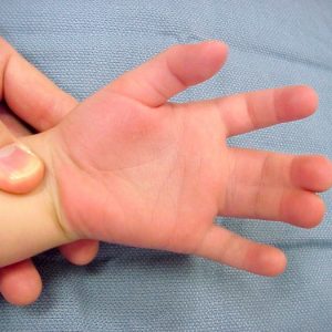 در این اختلال اتصال غیرنرمال دو انگشت را به هم مشاهده می کنیم و پیوستگی بین دو انگشت مخصوصا انگشت وسط و انگشت حلقه بسیار متداول است. همچنین می تواند بین انگشت شست و انگشت اشاره و یا هر دو انگشت دیگری هم اتفاق بیفتد. می تواند کل طول انگشت دچار اتصال گردد و یا می تواند فقط بخشی از طول انگشت را درگیر کرده باشد. می تواند فقط پوست و یا استخوان را هم درگیر کند.