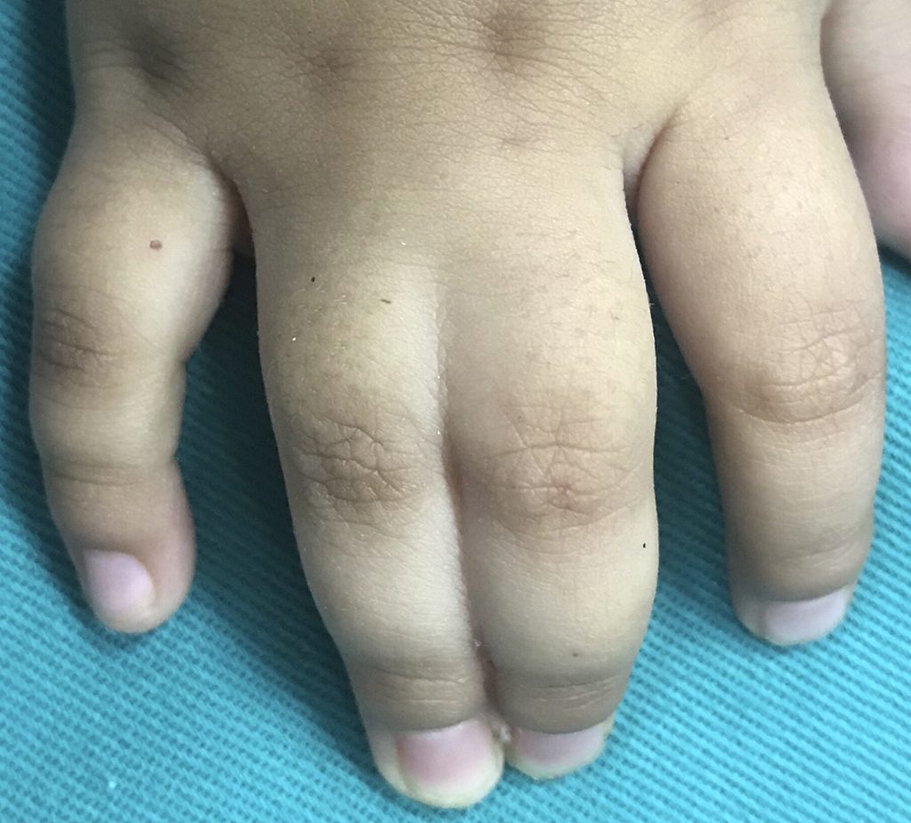 در این اختلال اتصال غیرنرمال دو انگشت را به هم مشاهده می کنیم و پیوستگی بین دو انگشت مخصوصا انگشت وسط و انگشت حلقه بسیار متداول است. همچنین می تواند بین انگشت شست و انگشت اشاره و یا هر دو انگشت دیگری هم اتفاق بیفتد. می تواند کل طول انگشت دچار اتصال گردد و یا می تواند فقط بخشی از طول انگشت را درگیر کرده باشد. می تواند فقط پوست و یا استخوان را هم درگیر کند.