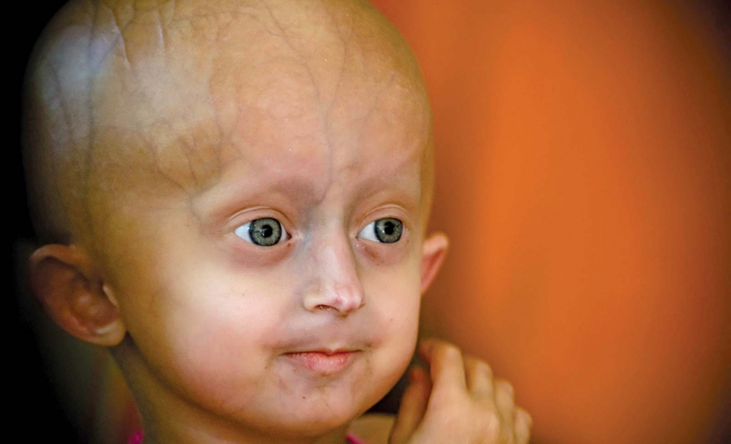 Progeria (pro-JEER-e-uh) یا پروجریا که همچنین به عنوان سندرم هاچینسون-گیلفورد شناخته می شود، یک اختلال ژنتیکی بسیار نادر و پیشرونده است که باعث می شود کودکان به سرعت پیر شوند و از دو سال اول زندگی شروع می شود. کودکان مبتلا به پروجریا معمولا در بدو تولد طبیعی به نظر می رسند. در طول سال اول، علائم و نشانه هایی مانند رشد آهسته و ریزش مو شروع می شود.