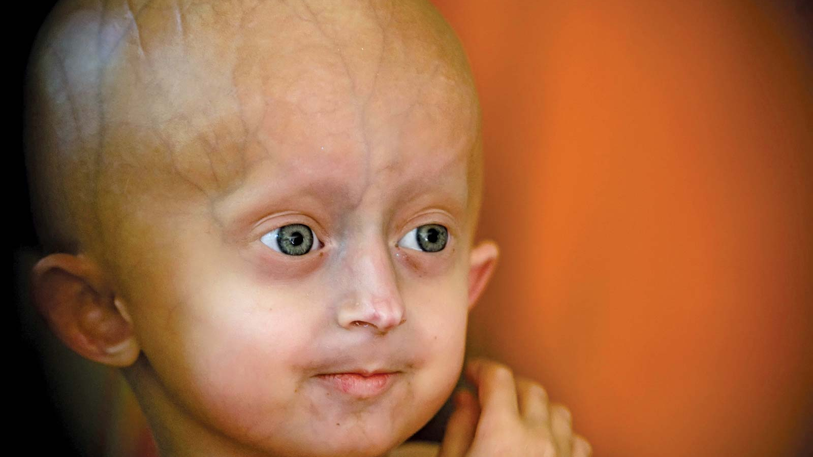 Progeria (pro-JEER-e-uh) یا پروجریا که همچنین به عنوان سندرم هاچینسون-گیلفورد شناخته می شود، یک اختلال ژنتیکی بسیار نادر و پیشرونده است که باعث می شود کودکان به سرعت پیر شوند و از دو سال اول زندگی شروع می شود. کودکان مبتلا به پروجریا معمولا در بدو تولد طبیعی به نظر می رسند. در طول سال اول، علائم و نشانه هایی مانند رشد آهسته و ریزش مو شروع می شود.