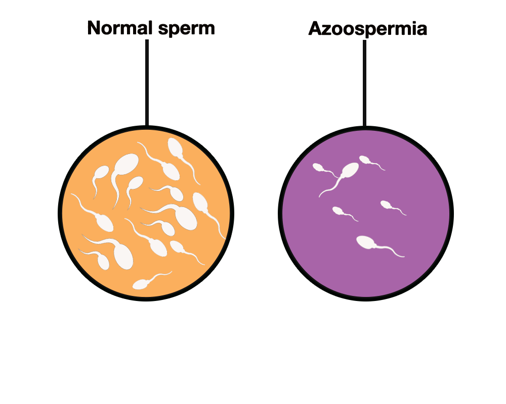 آزواسپرمی( Azoospermia) یک اصطلاح پزشکی است که در صورت عدم وجود اسپرم در انزال استفاده می شود. نبود اسپرم در مایع انزال به دلیل انسداد دستگاه تناسلی مرد (آزواسپرمی انسدادی) و یا به دلیل اختلال در تولید اسپرم از طریق بیضه ها(آزواسپرمی غیر انسدادی) رخ می دهد. 