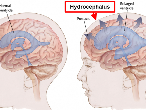 hydrocephalus (1)