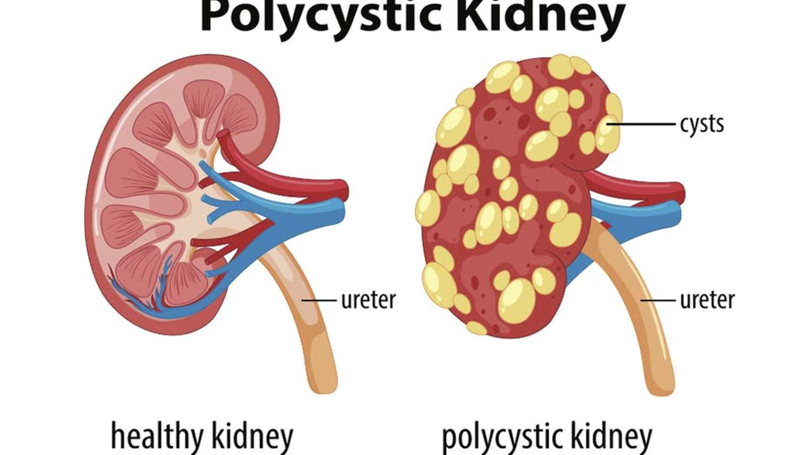 1600x960_146710-polycystic-kidney-disease
