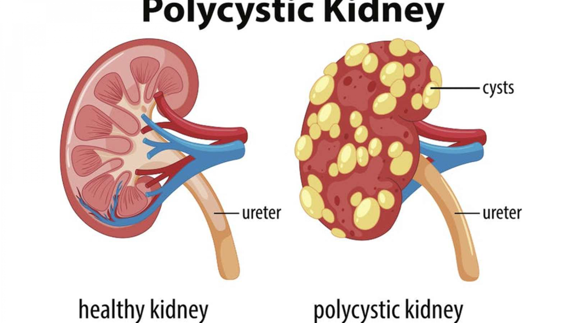 1600x960_146710-polycystic-kidney-disease