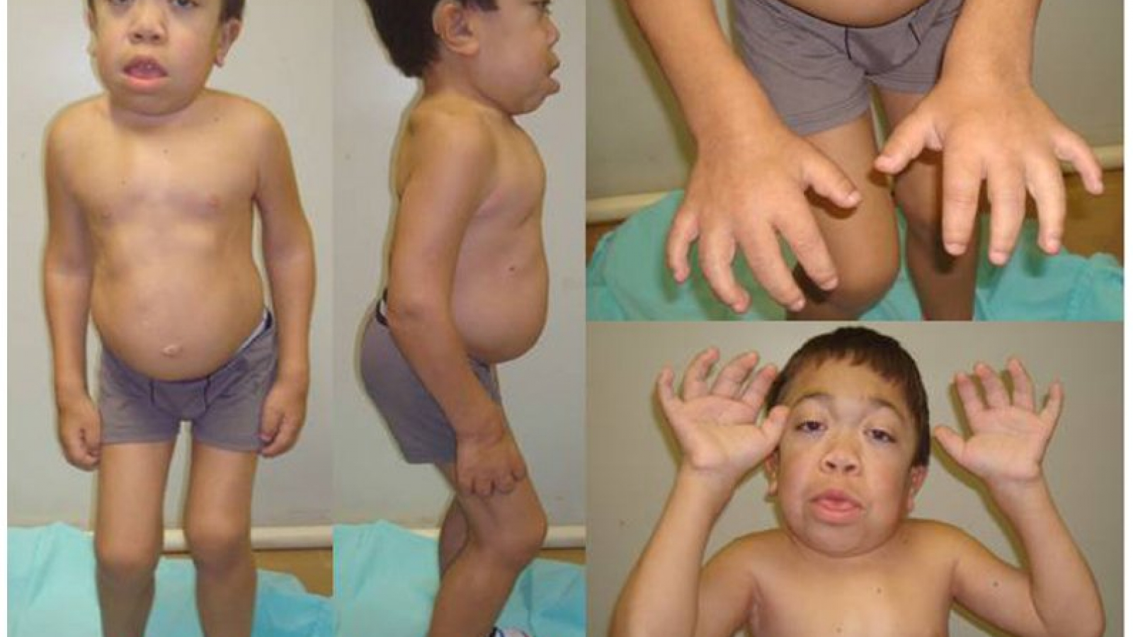 Maroteaux–Lamy syndrome