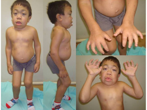 Maroteaux–Lamy syndrome