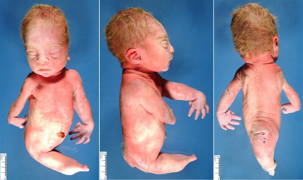 سندروم پری دریایی (Mermaid Syndrome) یک بیماری جدی است که در آن پاهای کودک در بدو تولد به صورت جزئی یا کامل به هم چسبیده اند. اغلب مبتلایان در اوایل زندگی میمیرند. این بیماری بسیار نادر است و از هر 60000 تا 100000 تولد در یک تولد رخ میدهد. 