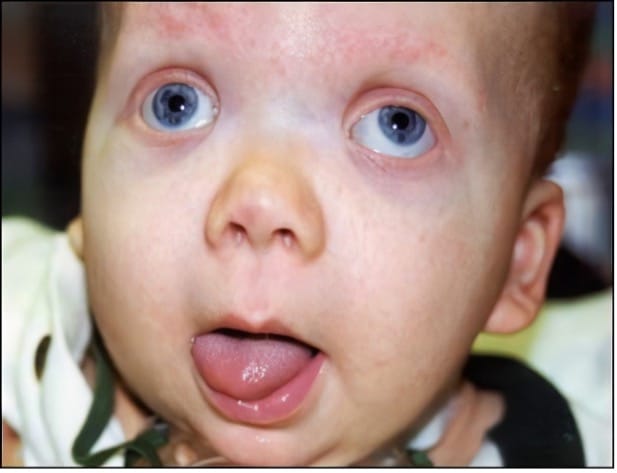 Beckwith-Wiedemann syndrome، شایع ترین اختلال رشد بیش از حد به علت ایجاد جهش در کروموزوم  11 و مستعد سرطان است که با برخی از اختلال های ژنتیکی ارتباط دارد. این بیماری به ندرت اتفاق می افتد و 20 درصد از مبتلایان دارای ایزودیزومی پدری هستند. چندین علت ژنتیکی برای این سندروم شناخته شده است که به دلیل ایجاد تغییراتی در بیان یک یا چند ژن روی کروموزوم 11 می باشد.