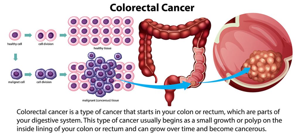 مراحل مختلف سرطان روده بزرگ و نحوه انتشار آن در بدن.