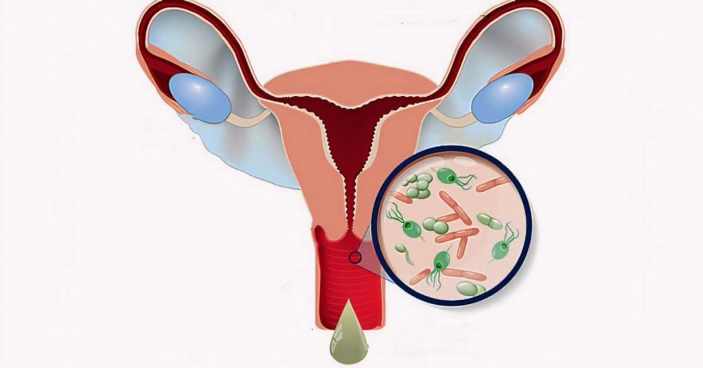 علائم عفونت قارچی واژن در بارداری شامل ترشحات سفید و خارش ناحیه تناسلی