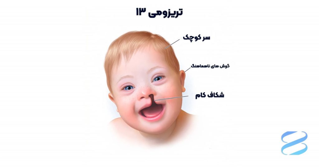 تصویر یک نوزاد مبتلا به تریزومی 13 با ناهنجاری های فیزیکی